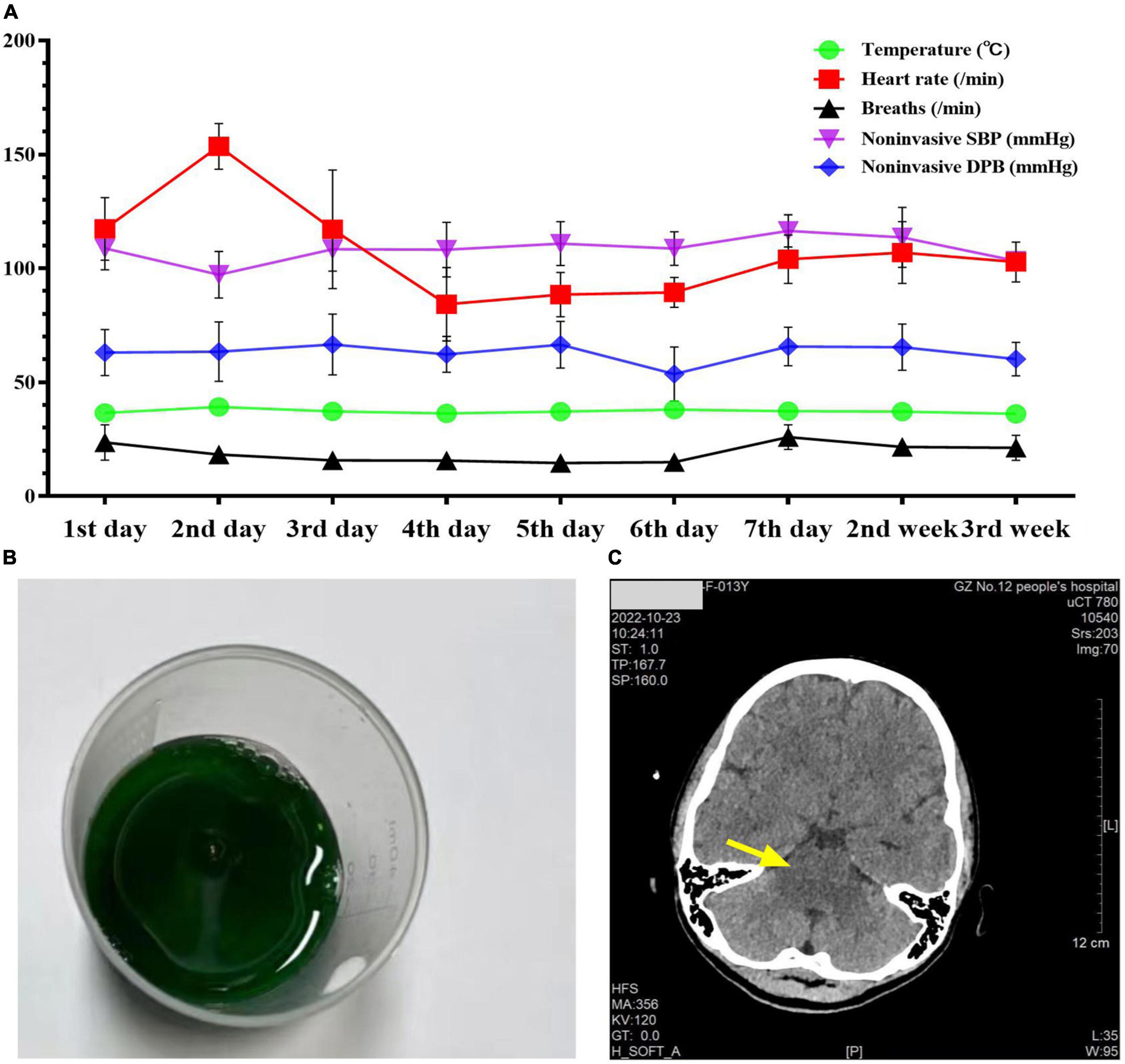 Case report: Successful outcome of a young patient with rhabdomyolysis and shock caused by diquat poisoning